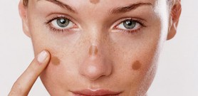 Cách khắc phục da bị thương tổn do trị nám sai cách