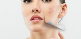 Những cách điều trị nám hiệu quả và đơn giản