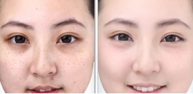Top kem trị nám hiệu quả tin dùng nhất hiện nay