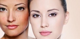 Trị nám da từ bộ đôi nhau thai cừu