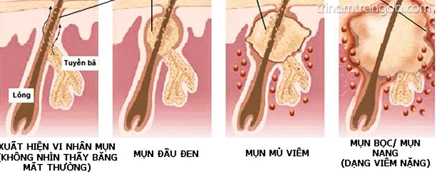 Cách chăm sóc da nhờn vào ngày hè 2