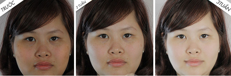 Sau 3 tuần kết hợp sử dụng phương pháp tự nhiên trị nám và Bộ kem trị nám trắng da Beauty Care