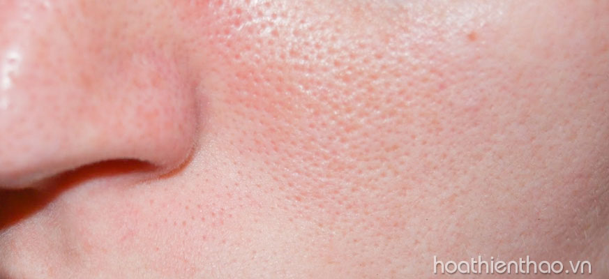Ưu và khuyết điểm của da nhờn 3