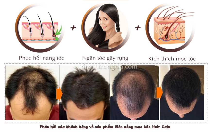 Hiệu quả trước và sau khi uống thuốc trị rụng tóc
